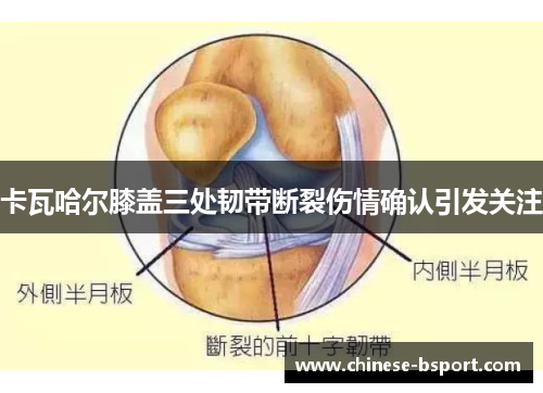 卡瓦哈尔膝盖三处韧带断裂伤情确认引发关注 卡瓦哈尔膝盖三处韧带断裂伤情确认引发关注